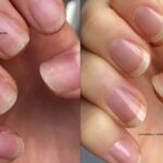 Before and after results of using Kester Black Miracle Treatment Base Coat for nail care