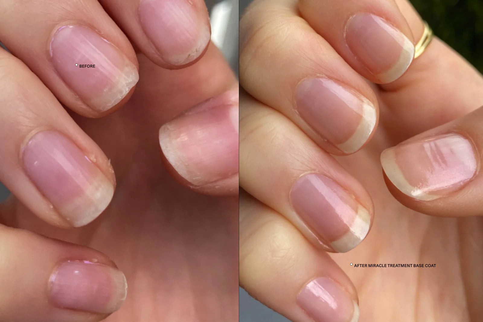 Before and after results of using Kester Black Miracle Treatment Base Coat for nail care